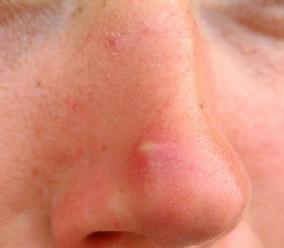 Прыщи на носу: причины и лечение