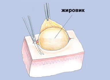 Удаление липомы (жировика) хирургическим путем
