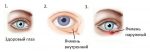 Эффективные способы лечения ячменя на глазу