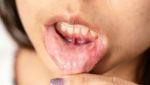Почему проблемы с желудком могут вызывать язвы во рту?